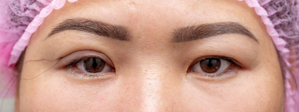 Results After Ptosis Correction Singapore